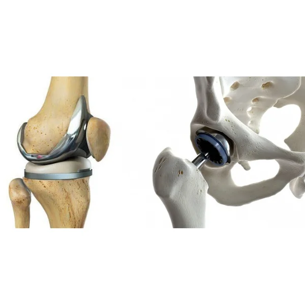 Joint Replacement